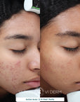 Signature Customized Peel