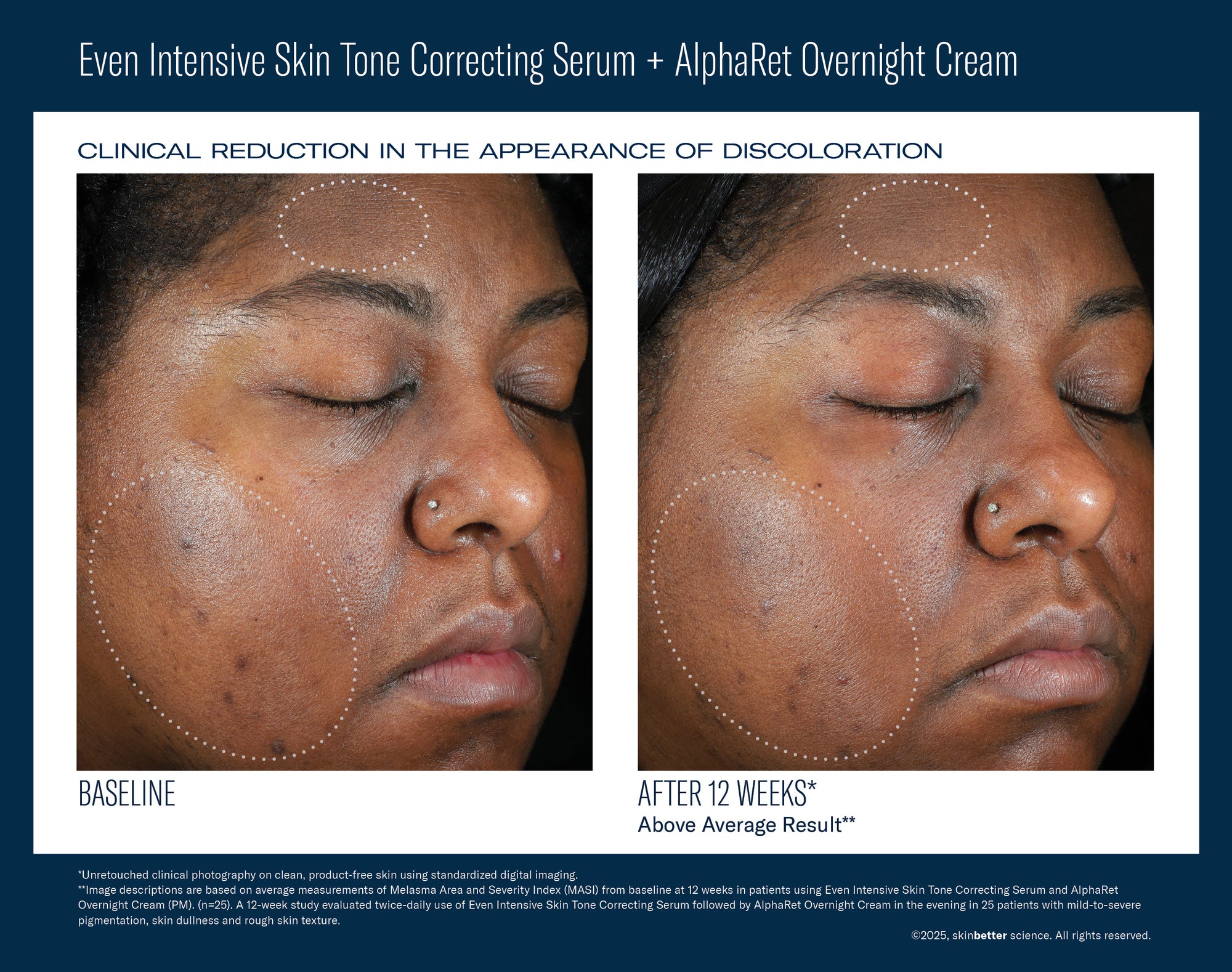 SkinBetter - Even Intensive Skin Tone Correcting Serum