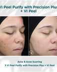 Signature Customized Peel