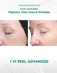 Signature Customized Peel