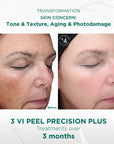 Signature Customized Peel