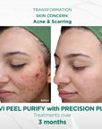 Signature Customized Peel