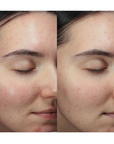 Anfisa - ÂN-DEW 10% Azelaic Acid + PHA Serum