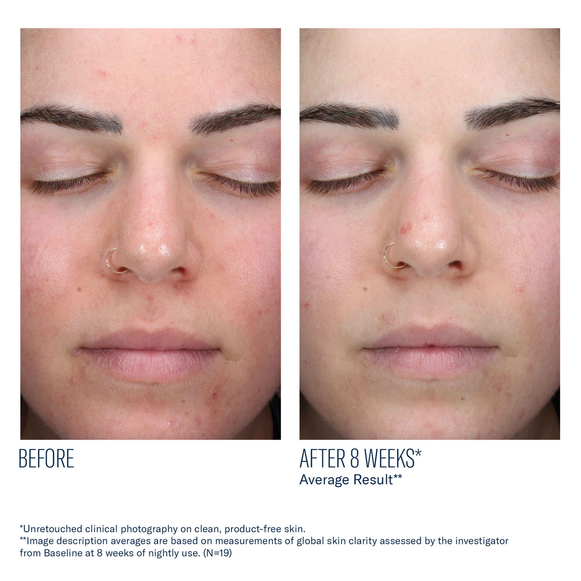 SkinBetter - AlphaRet Clearing Serum - 1 oz