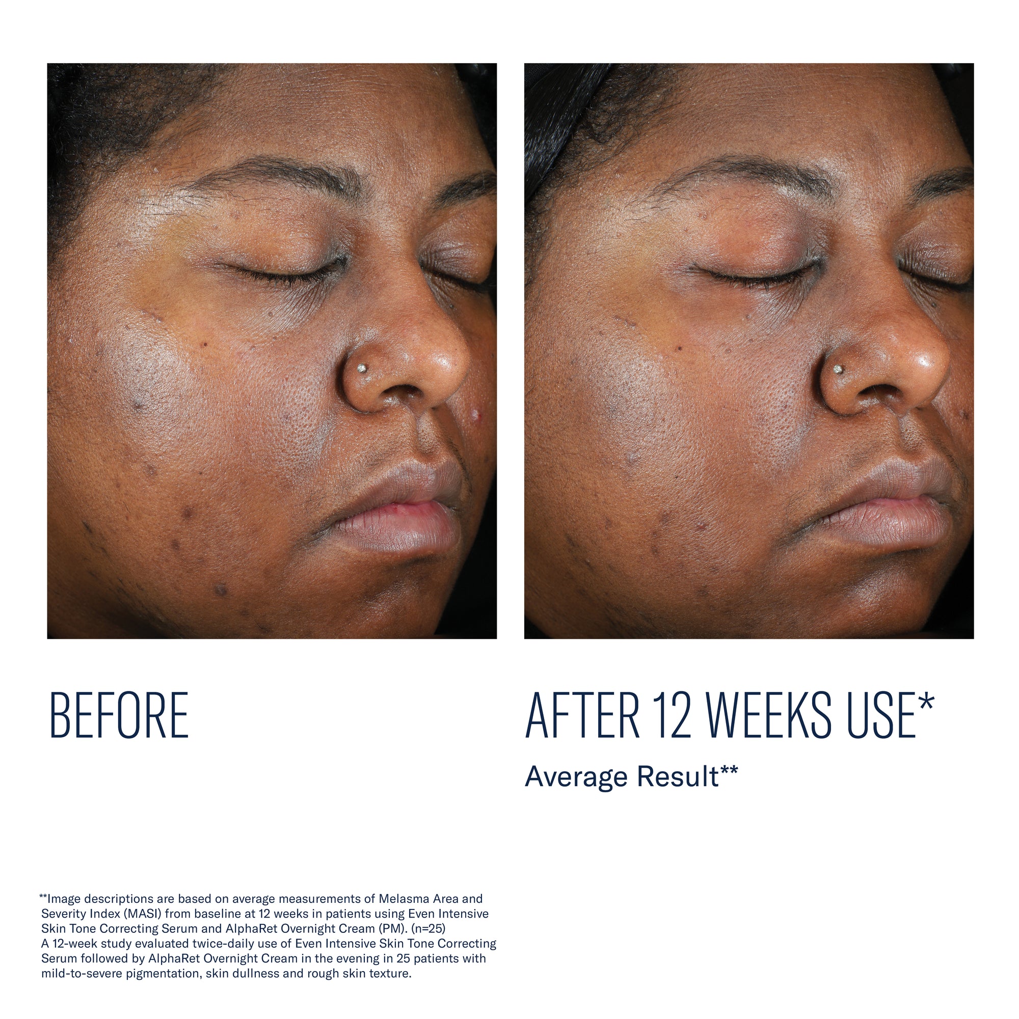 SkinBetter - Even Intensive Skin Tone Correcting Serum