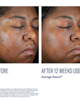 SkinBetter - Even Intensive Skin Tone Correcting Serum