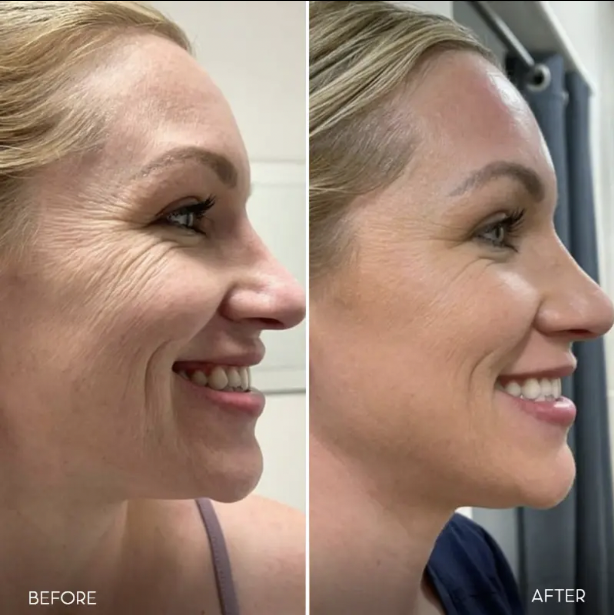 Facial Contouring &amp; Lifting
